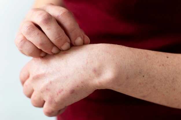 Rash with Clopidogrel: Understanding the Skin Reaction