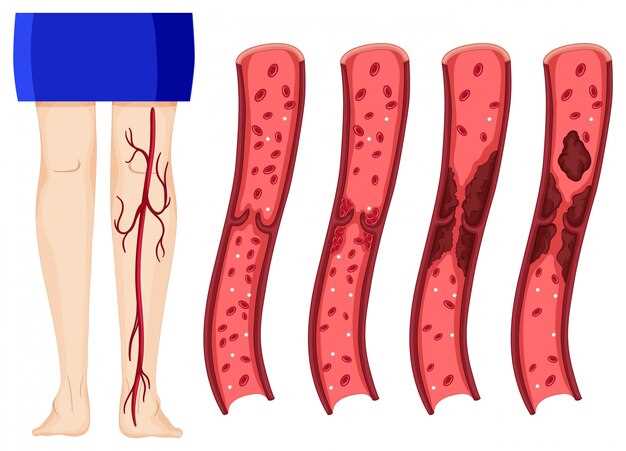 Ticagrelor vs clopidogrel stent